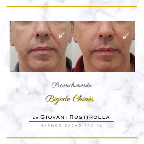 H - bbigode chines